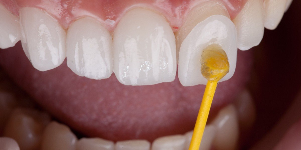 Resultado carillas 1